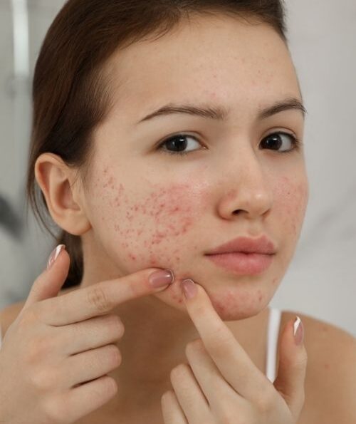 teen facial herndon va